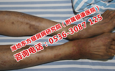 牛皮癬患者在日常應(yīng)該注意什么
