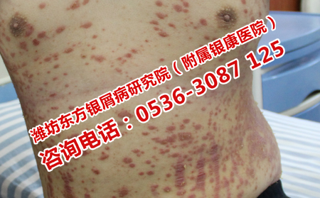 哪個醫(yī)院治療牛皮癬有效果