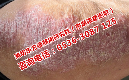 具體哪些因素導(dǎo)致牛皮癬