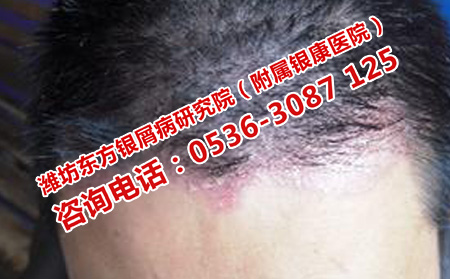 頭部牛皮癬應(yīng)該怎樣護理