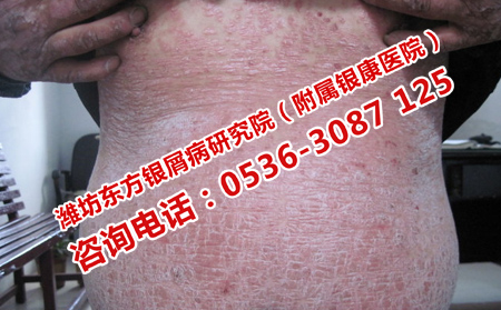 高中生為什么突發(fā)牛皮癬