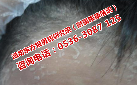 得了牛皮癬應(yīng)該怎樣治療