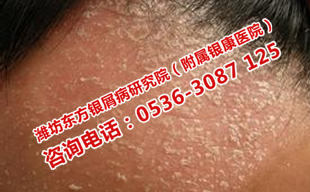 治療牛皮癬注意什么細(xì)節(jié)