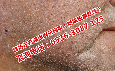 預防牛皮癬的秋季復發(fā)