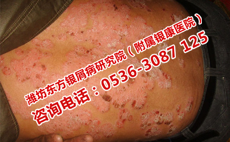 如何預(yù)防銀屑病頻繁復(fù)發(fā)