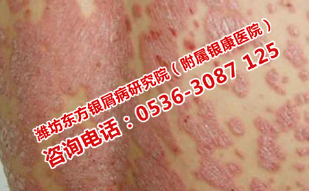 濰坊治療銀屑病的專科醫院