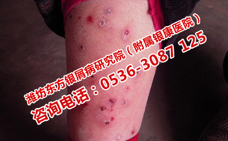 濰坊銀屑病醫(yī)院治療費