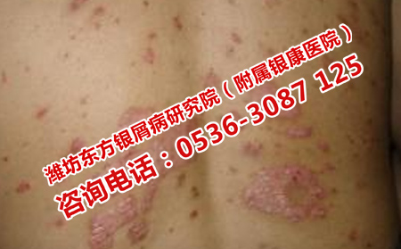 中醫(yī)治療銀屑病的副作用