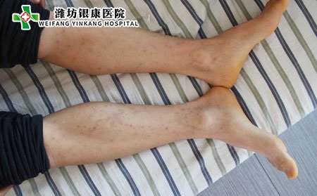 濰坊牛皮癬醫院：牛皮癬遺傳怎么辦?